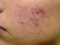 Acne Case 3580 Before Photo Acne