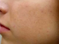 Acne Case 3580 After Photo Acne