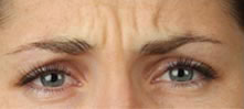 Botox Case 3590 Before Photo Botox
