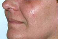 Chemical Skin Peel Case 3600 After Photo Chemical Skin Peel