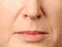 Juvederm Case 3619 Before Photo Juvederm