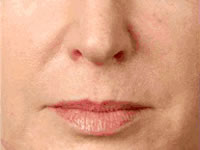 Juvederm Case 3619 After Photo Juvederm