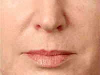 Juvederm