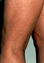 Sclerotherapy