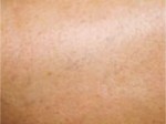 Vbeam Laser