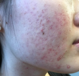 Microneedling Case 4792 Before Photo Microneedling