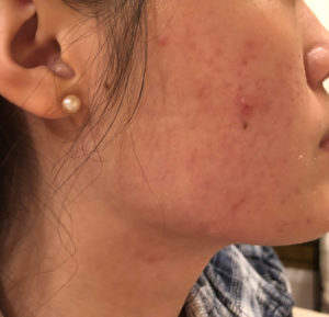 Microneedling