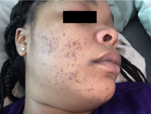 Acne Case 4862 Before Photo Acne