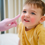 pediatric dermatologist is applying allergy cream to the baby's cheek