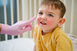 pediatric dermatologist is applying allergy cream to the baby's cheek