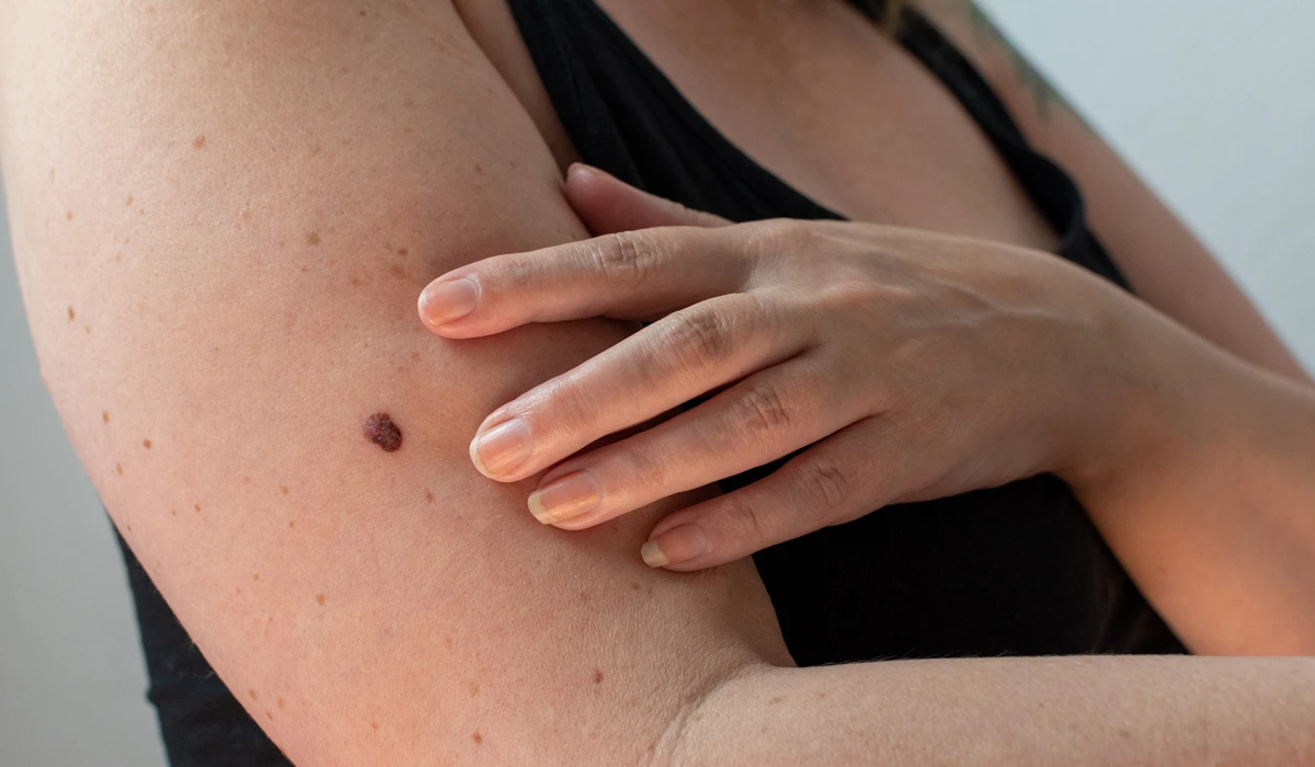 melanoma-risk-factors Image showing a person's upper arm with a prominent, irregular mole (nevus) among many freckles, representing a common risk factor for melanoma and the importance of skin checks.