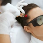 Woman At Hair Growth Laser Stimulation Treatment Woman At Hair Growth Laser Stimulation Treatment
