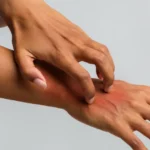 Woman scratching her hand, suffering from psoriasis