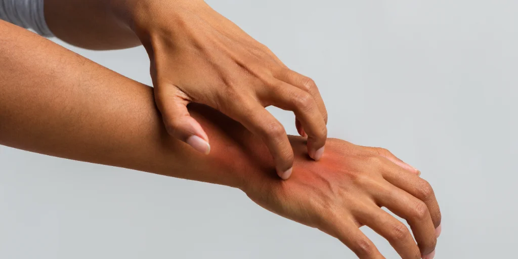 Woman scratching her hand, suffering from psoriasis