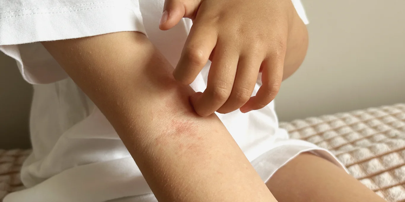 Child scratching irritated skin on arm due to rash or allergy