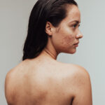 Woman with skin problems