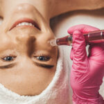 Cosmetologist's hand doing procedure of microneedling to the patient's smiling face.