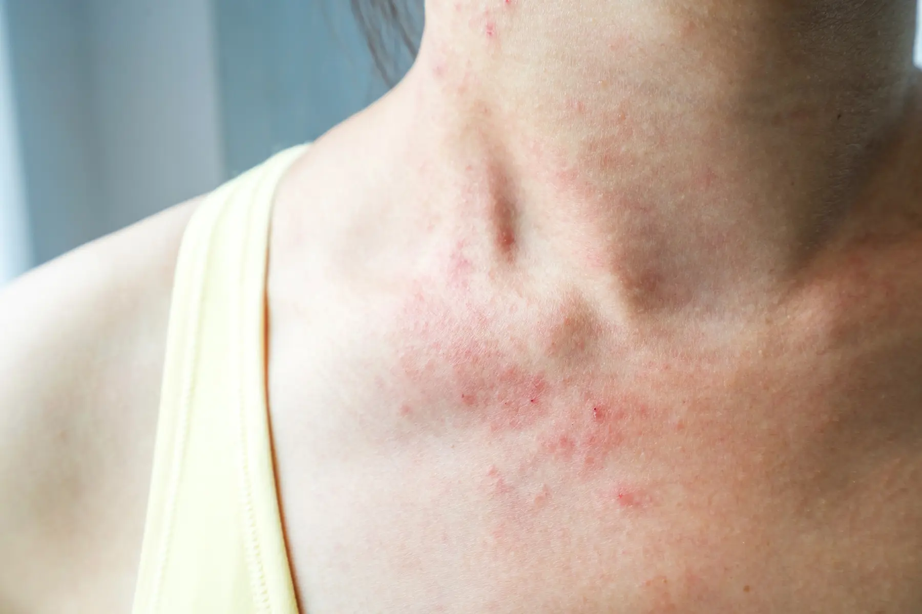 Red rash on woman's neck and chest, showing irritation and inflammation.
