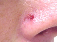 Basal Cell Carcinoma on Nose