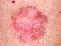 Basal Cell Carcinoma