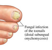 Toenail Fungus