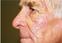 Vbeam® Laser Treatment