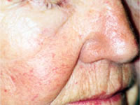 Vbeam® Laser Treatment for Rosacea