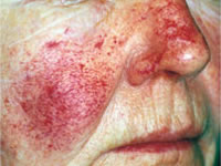 Rosacea