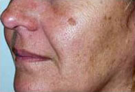 Before Chemical Peel Treatment