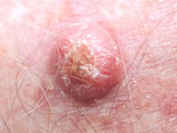 Squamous Cell Carcinoma