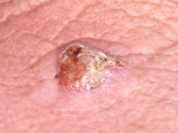 Squamous Cell Carcinoma