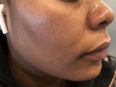 Before and after photos showing a person's skin with reduced acne after treatment
