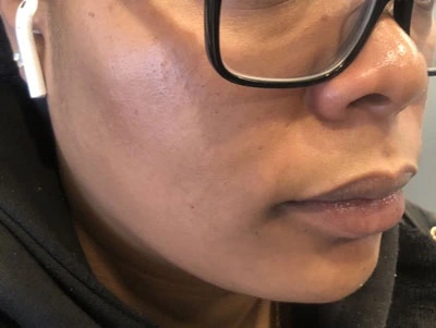 Before and after photos showing a person's skin with reduced acne after treatment