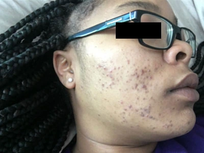 Before and after photos showing a person's skin with reduced acne after treatment